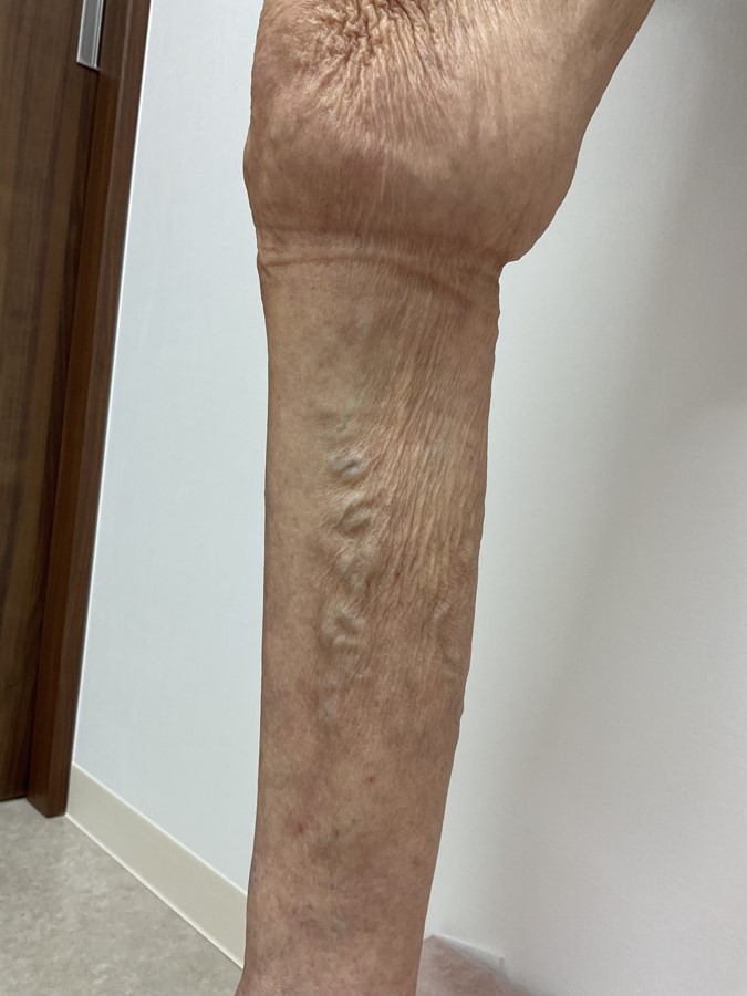 下肢静脈瘤の症例