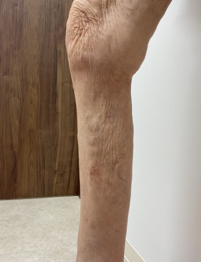 下肢静脈瘤の症例