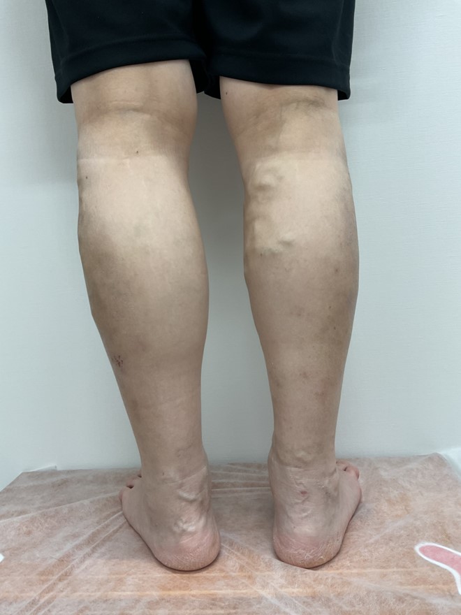 下肢静脈瘤の症例