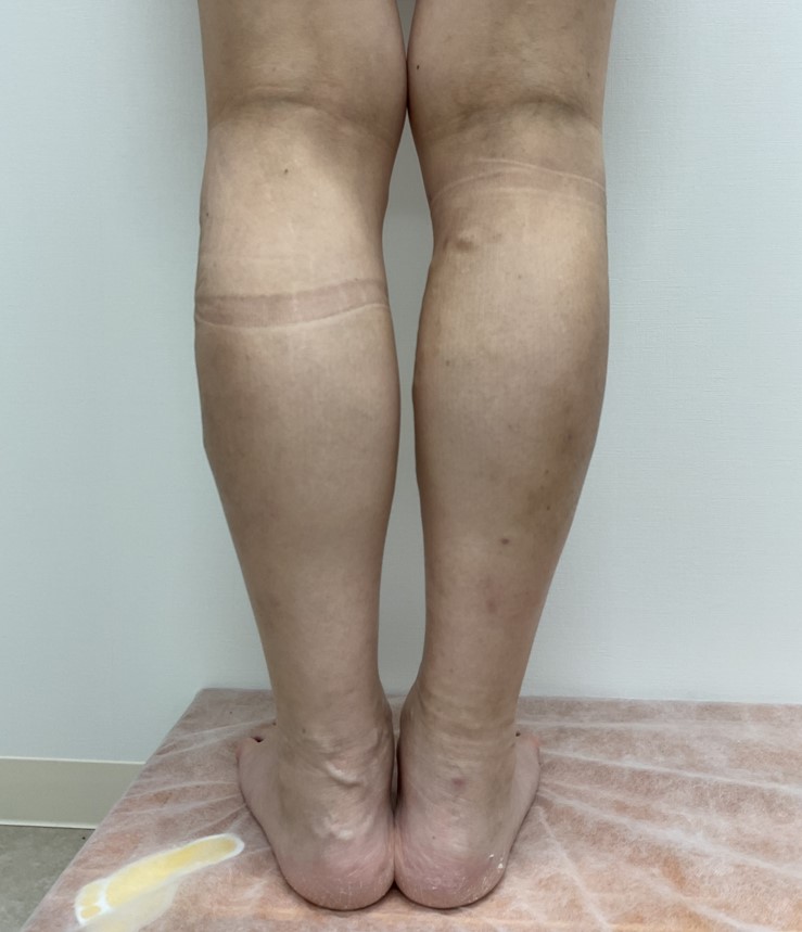 下肢静脈瘤の症例