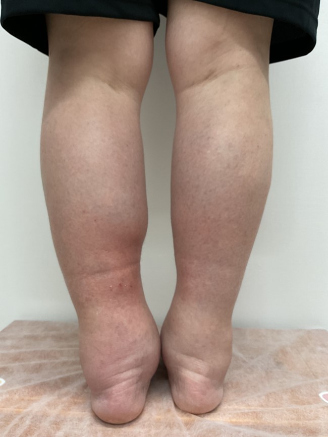 下肢静脈瘤の症例