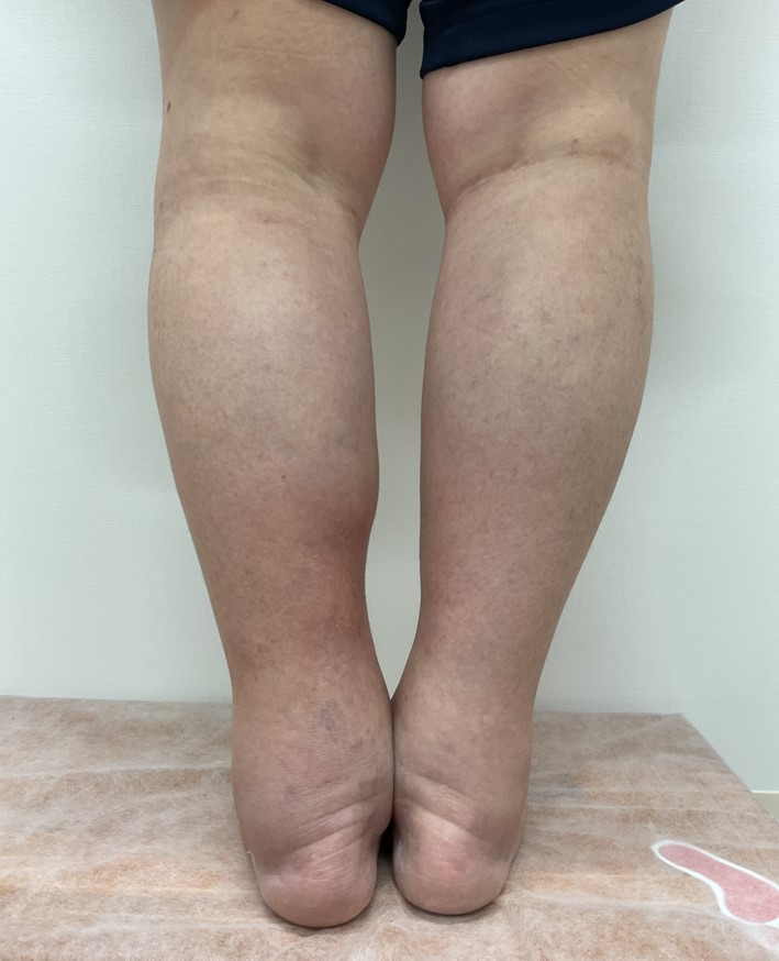 下肢静脈瘤の症例