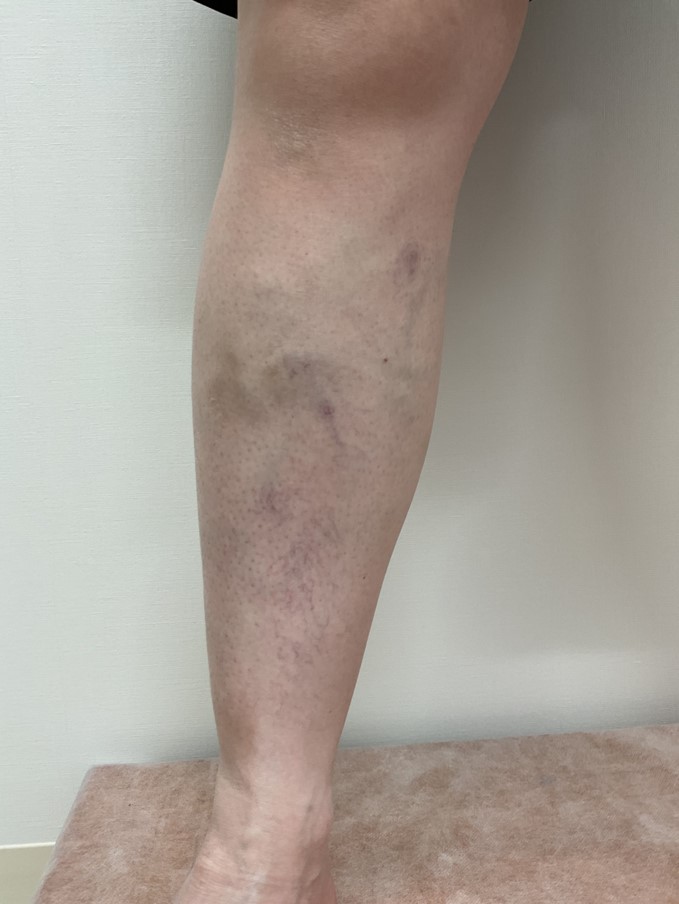 下肢静脈瘤の症例