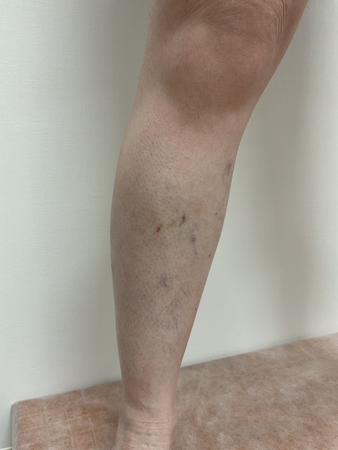下肢静脈瘤の症例