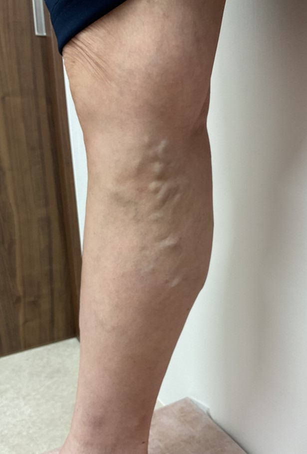 下肢静脈瘤の症例