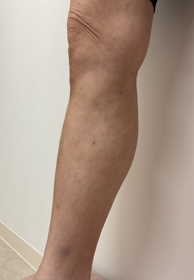 下肢静脈瘤の症例