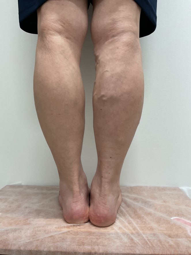 下肢静脈瘤の症例
