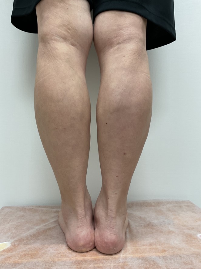 下肢静脈瘤の症例