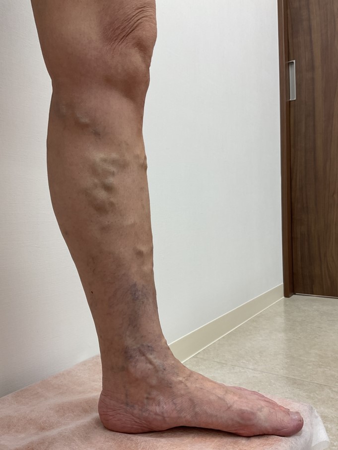 下肢静脈瘤の症例