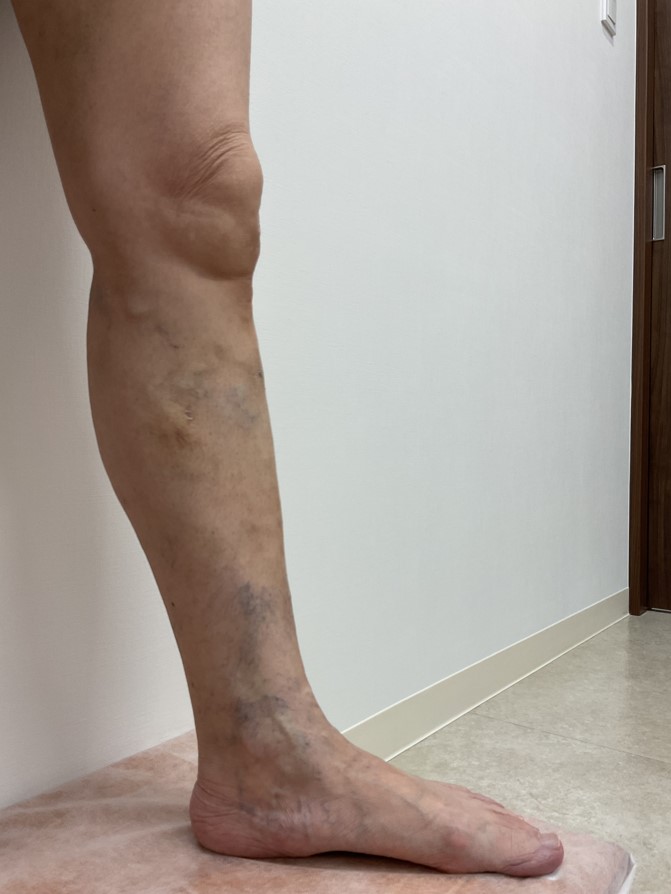 下肢静脈瘤の症例