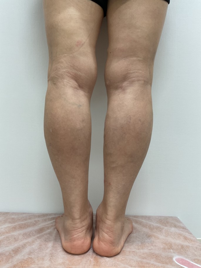 下肢静脈瘤の症例