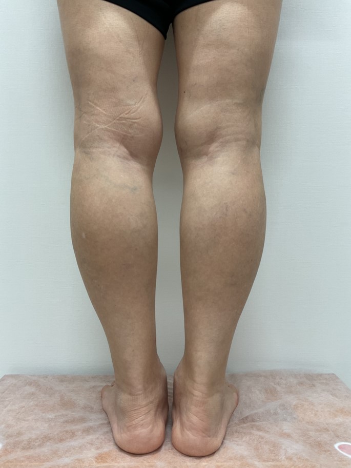下肢静脈瘤の症例
