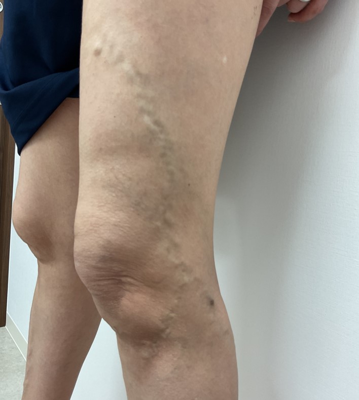 下肢静脈瘤の症例