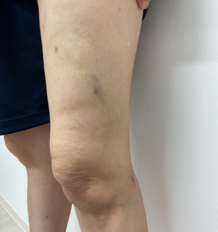 下肢静脈瘤の症例