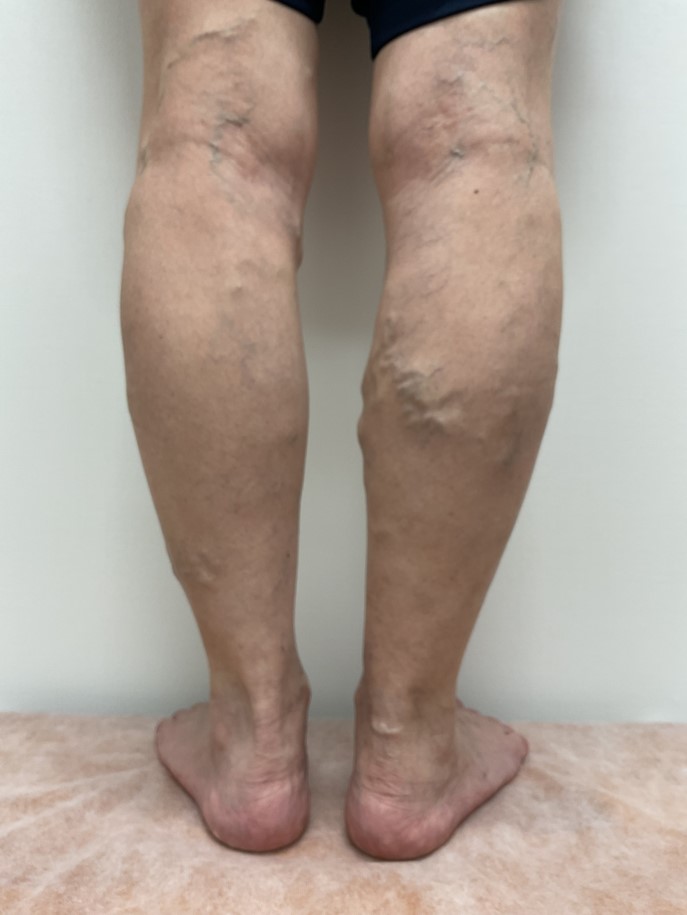 下肢静脈瘤の症例
