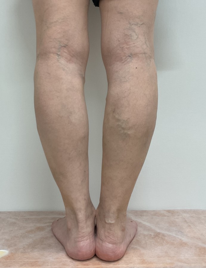 下肢静脈瘤の症例