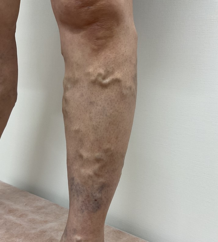 下肢静脈瘤の症例