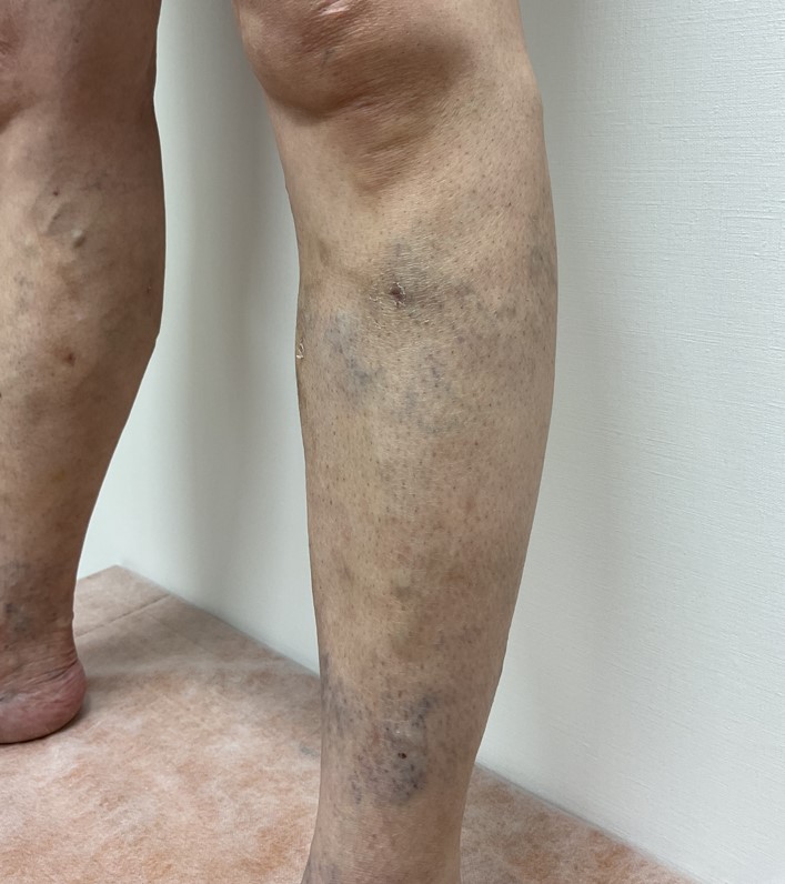 下肢静脈瘤の症例