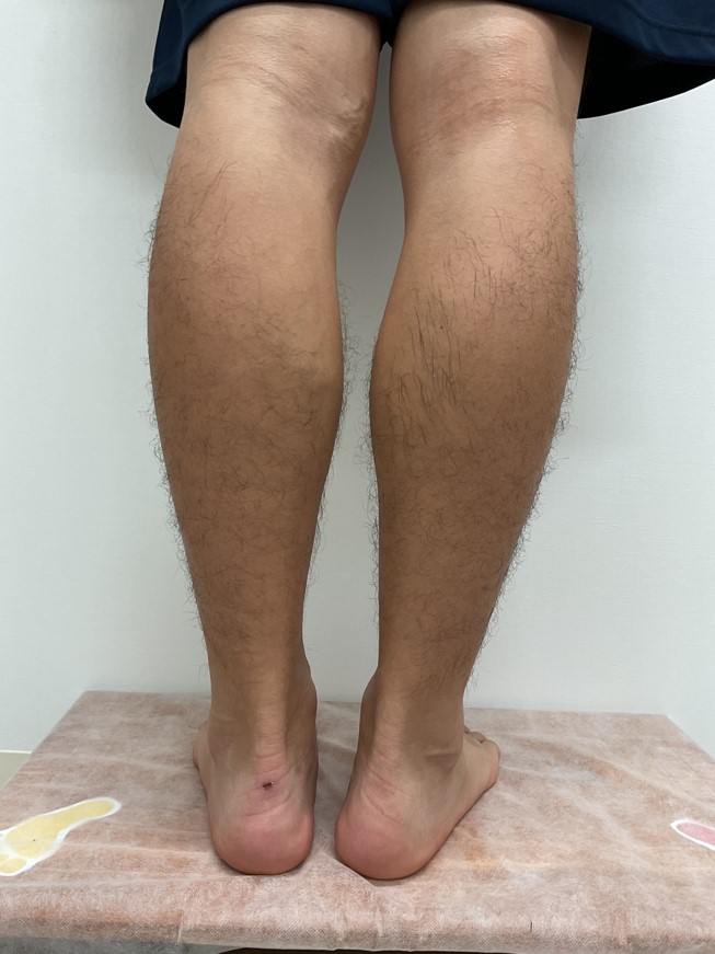 下肢静脈瘤の症例