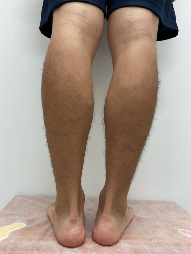 下肢静脈瘤の症例