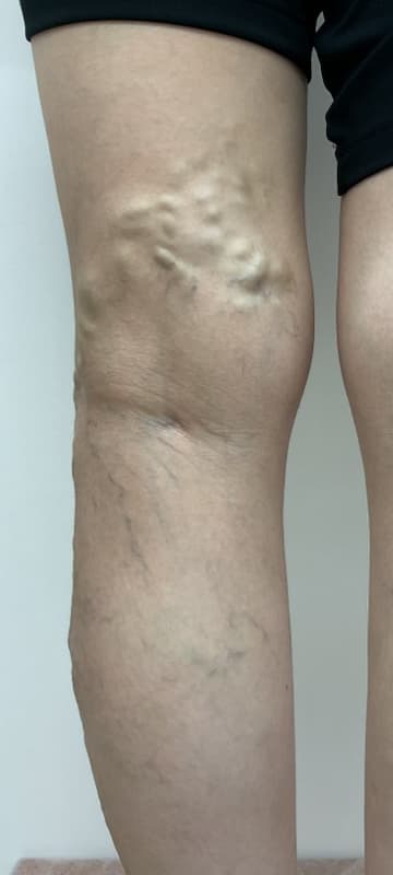 下肢静脈瘤の症例