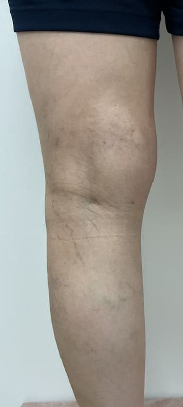 下肢静脈瘤の症例