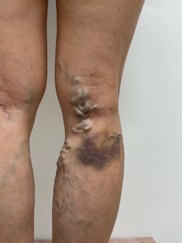 下肢静脈瘤の症例