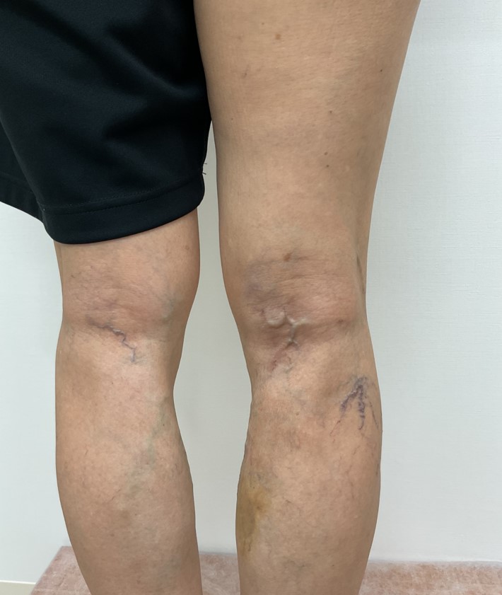 下肢静脈瘤の症例