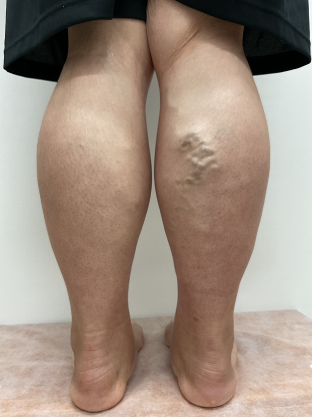 下肢静脈瘤の症例