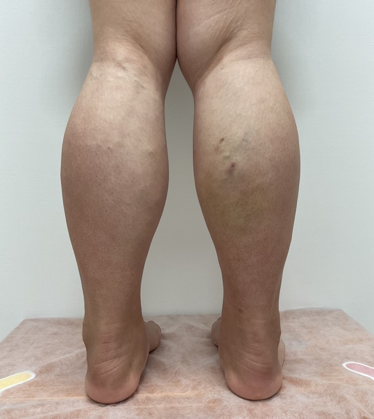 下肢静脈瘤の症例