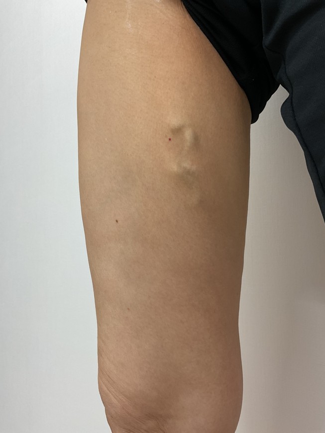 下肢静脈瘤の症例