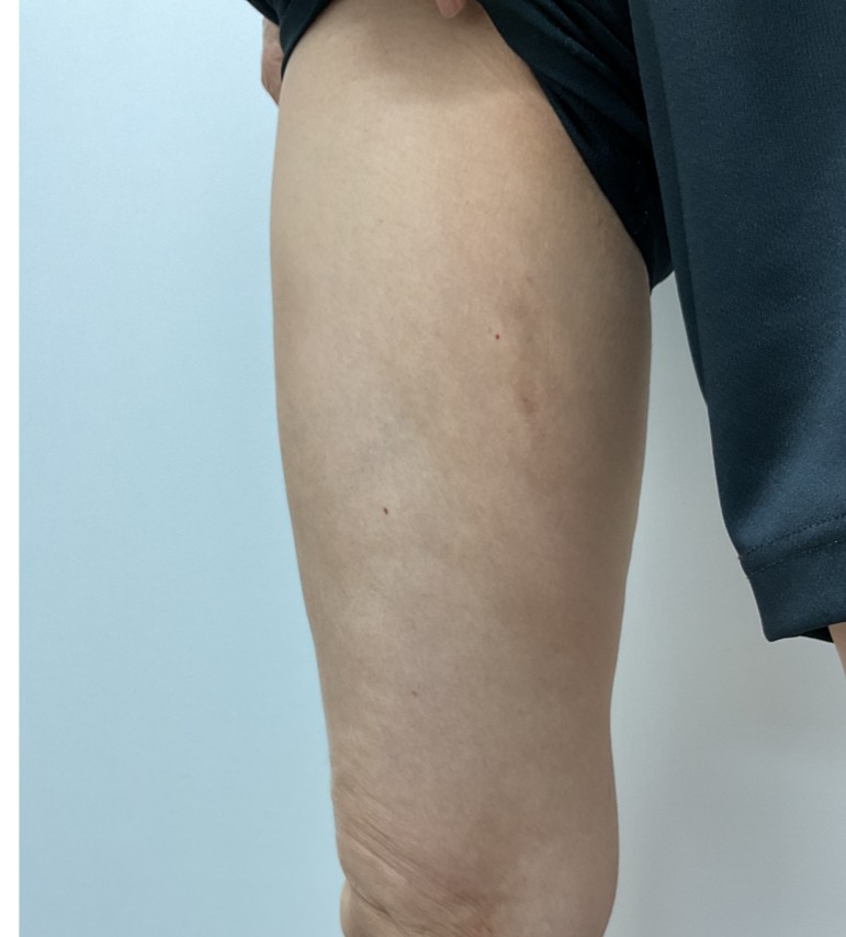 下肢静脈瘤の症例