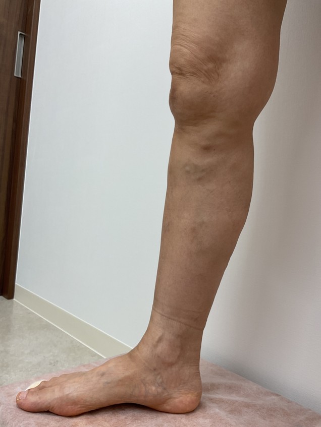 下肢静脈瘤の症例