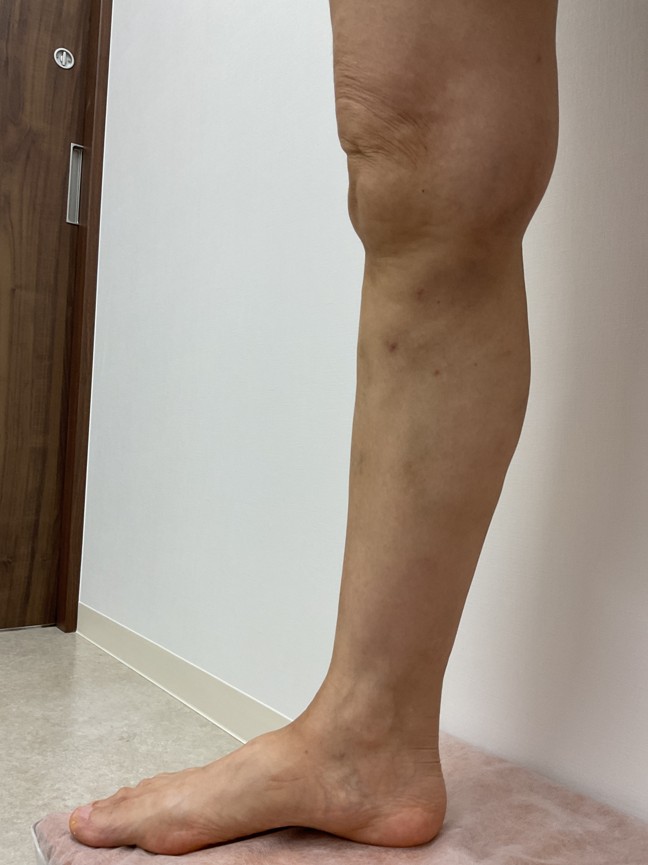 下肢静脈瘤の症例