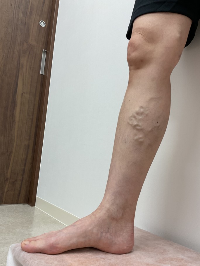 下肢静脈瘤の症例