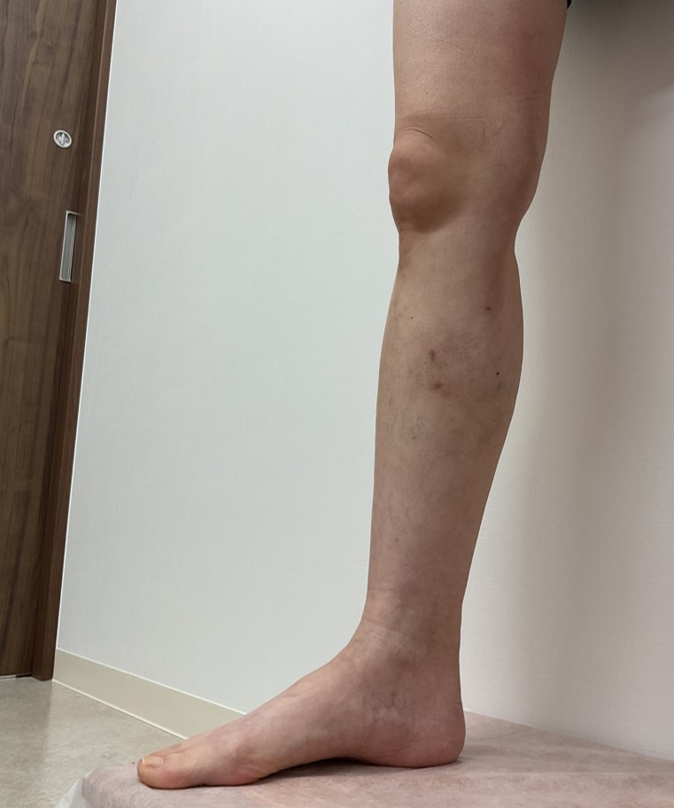 下肢静脈瘤の症例