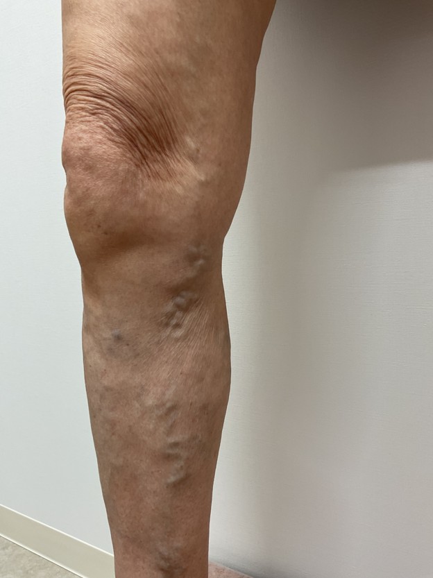 下肢静脈瘤の症例