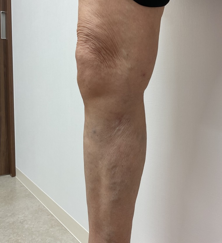 下肢静脈瘤の症例