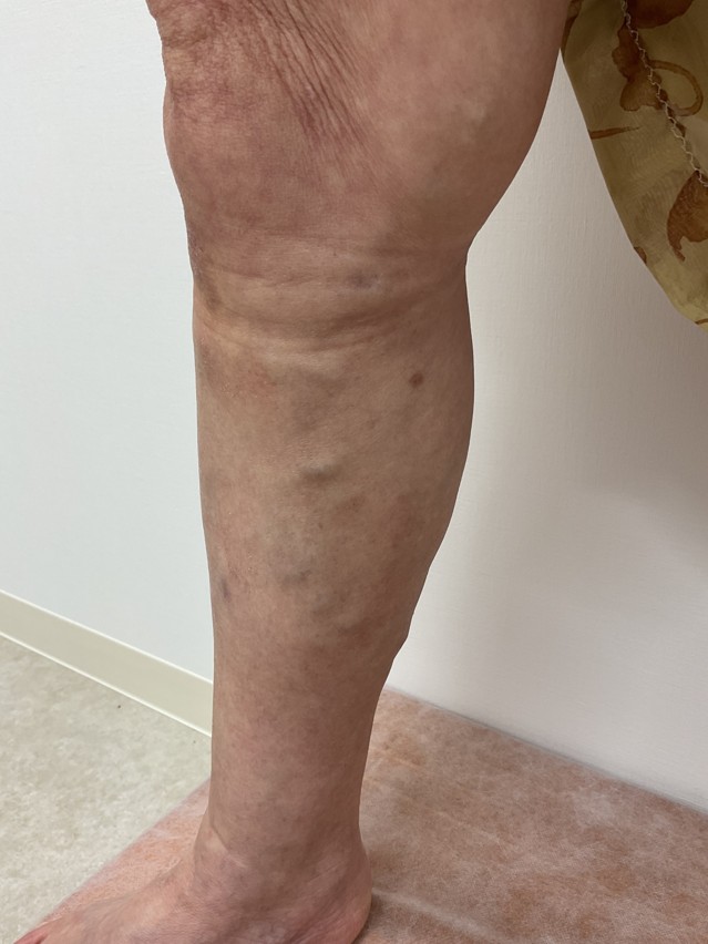 下肢静脈瘤の症例