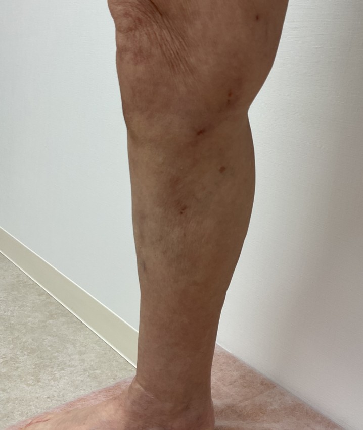 下肢静脈瘤の症例