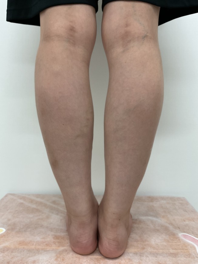 下肢静脈瘤の症例