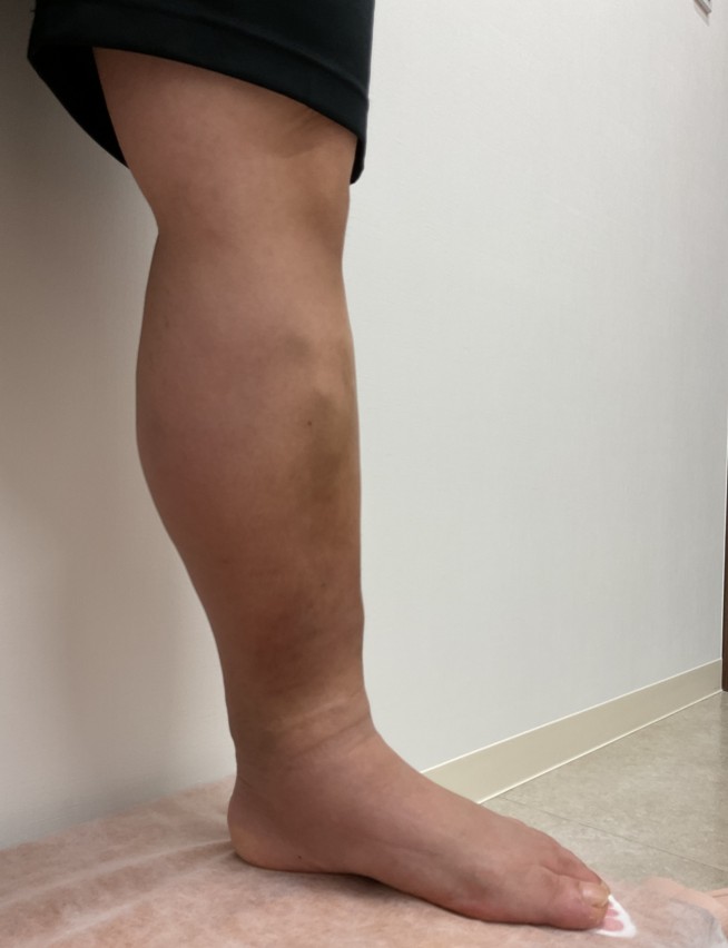 下肢静脈瘤の症例