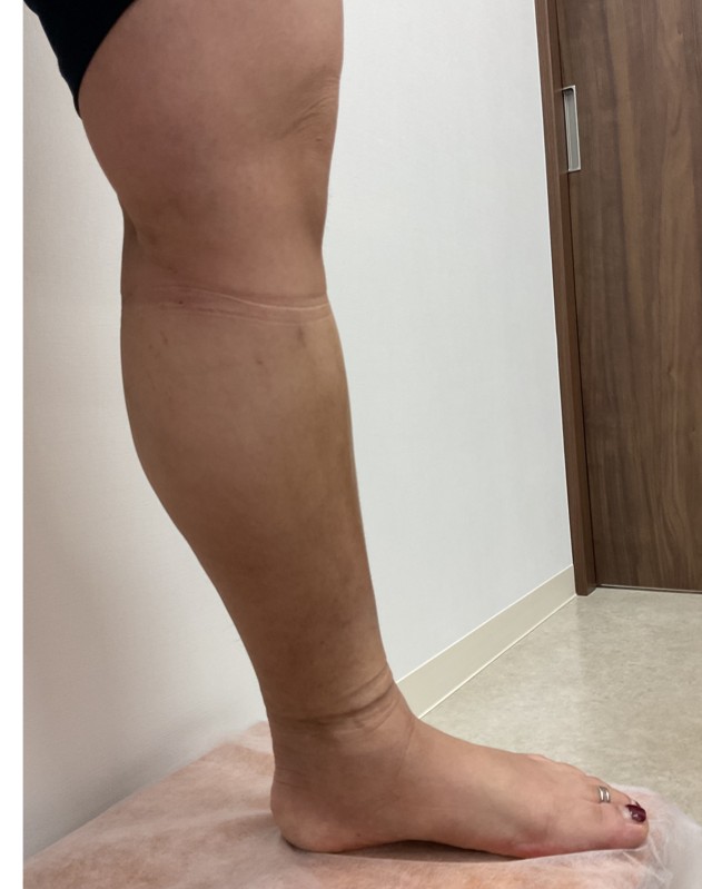 下肢静脈瘤の症例