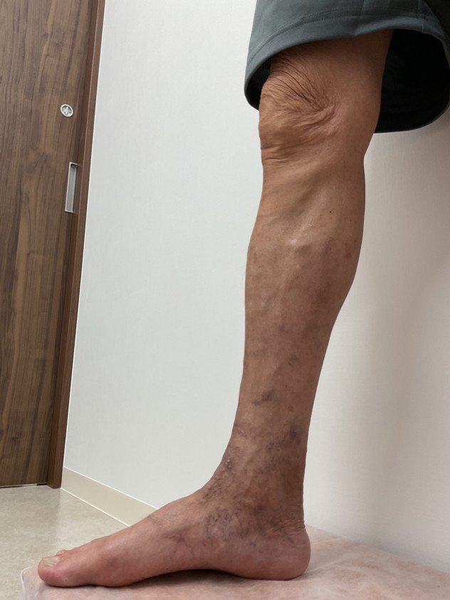 下肢静脈瘤の症例