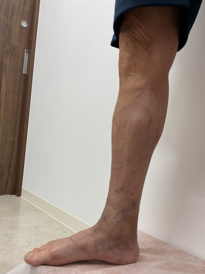 下肢静脈瘤の症例