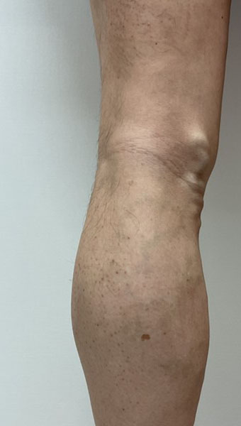 下肢静脈瘤の症例