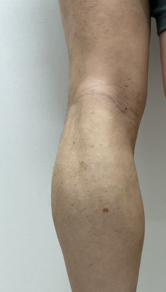 下肢静脈瘤の症例