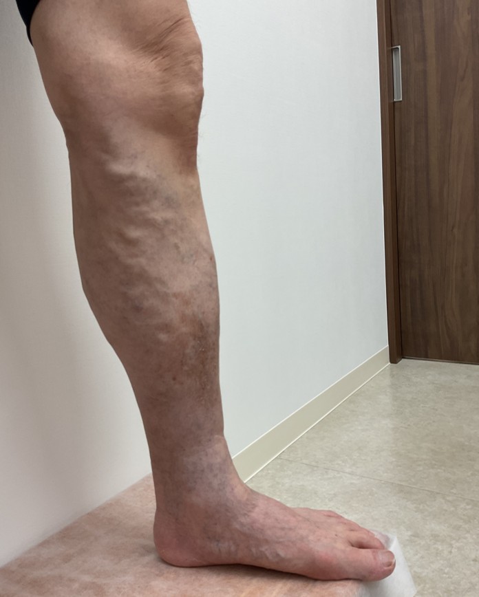 下肢静脈瘤の症例