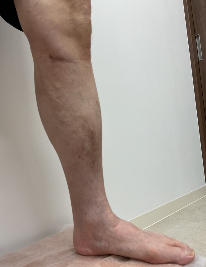 下肢静脈瘤の症例