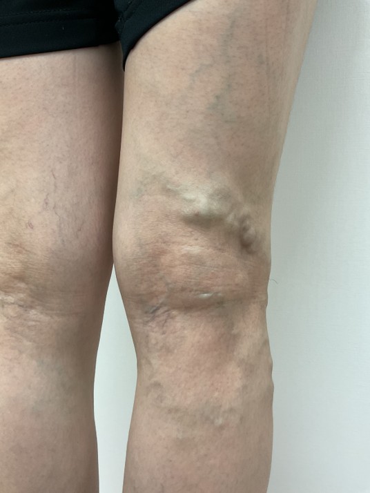 下肢静脈瘤の症例